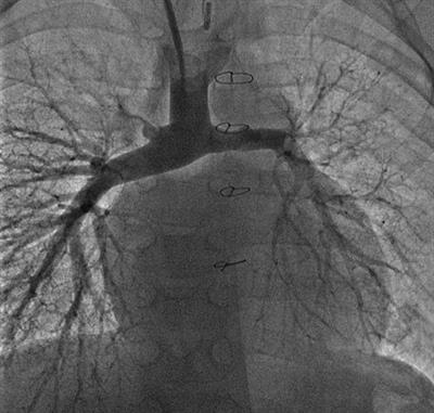 Case report and review of the literature: Successful transition from acute continuous veno-venous hemodiafiltration therapy to chronic peritoneal dialysis in a chronically ventilated child with hypoplastic left heart syndrome following fontan